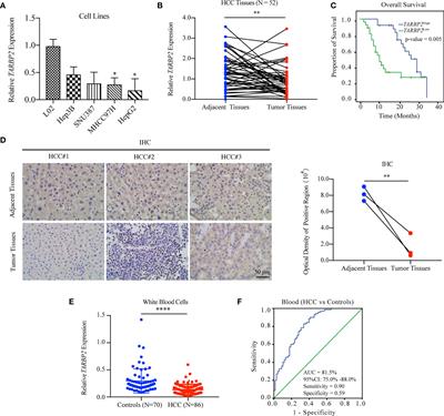 Loss of TARBP2 Drives the Progression of Hepatocellular Carcinoma via miR-145-SERPINE1 Axis